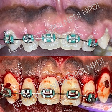 A photo of crown lengthening