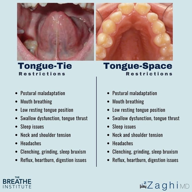 A photo describing tongue-tie vs. tongue-space