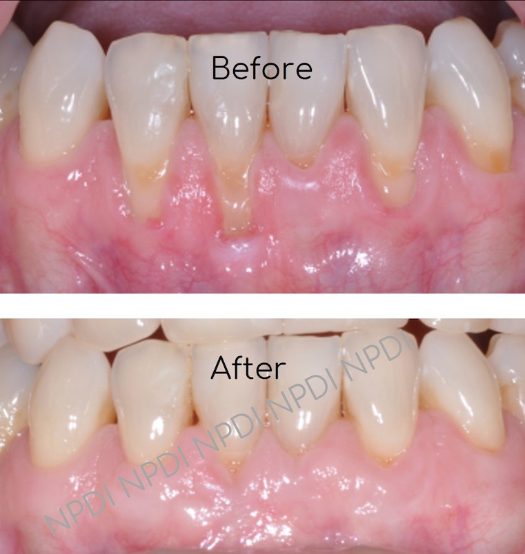 A photo showing before and after Mucogingival Deformity